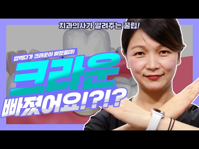 치과 치료했던 크라운이 밥먹다 빠졌어요ㅠㅠ 치과의사가 알려주는 꿀팁 | 강남 아름드리치과