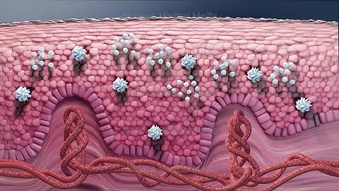 How to Treat Psoriasis