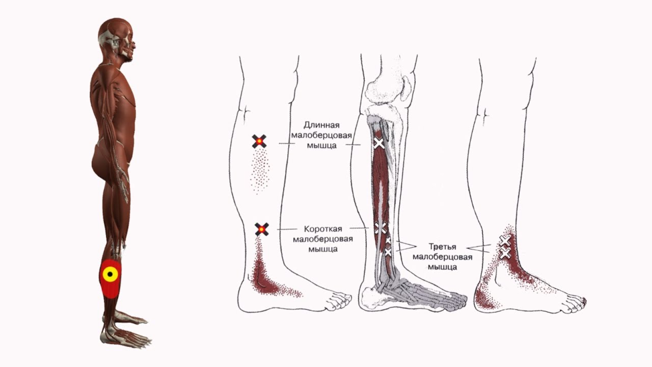 Почему болит голень при ходьбе. Триггерные точки большеберцовой мышцы голени. Триггерные точки голеностопного сустава. Триггерные точки передней большеберцовой мышцы. Триггерные точки мышц стопы и голени.