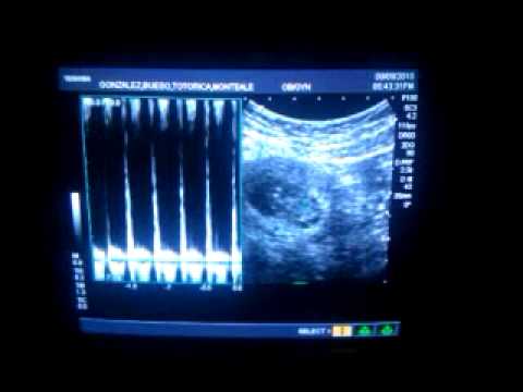 our unborn baby's heartbeat - YouTube