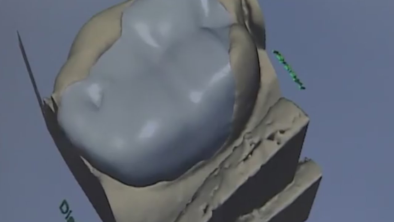 Cerec-Restauration - Vollkeramischer Zahnersatz