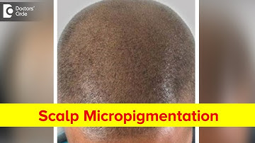What is scalp micropigmentation? - Dr. Vignesh Raj