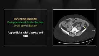 Appendicitis | Interesting Radiology Cases