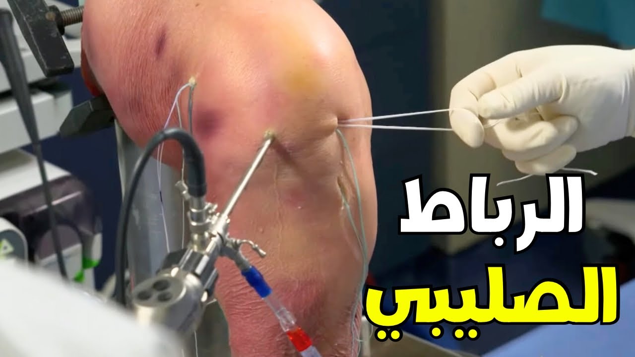 شاهد عملية الرباط الصليبي _ Anterior Cruciate Ligament (ACL) Surgery