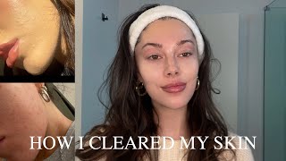 How I cleared my skin by Jourdan Sloane 43,308 views 1 year ago 10 minutes, 58 seconds