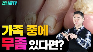 무좀 없애고 싶다면 이렇게 하세요! 완벽치료방법