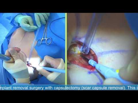 Breast Implant Removal | Capsulectomy: Live Streaming Plastic Surgery by Dr Michael J. Brown