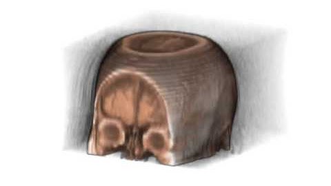 MRI AD Subject - William Edward Hahn