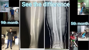 My TIBIA and FIBULA Full Healing Recovery Video