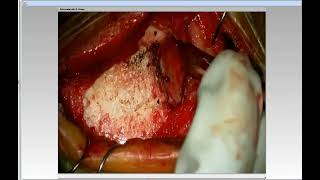 Supratentorial Arteriovenous Fistulas: Nuances of Technique for Microsurgical Ligation (Preview) screenshot 5