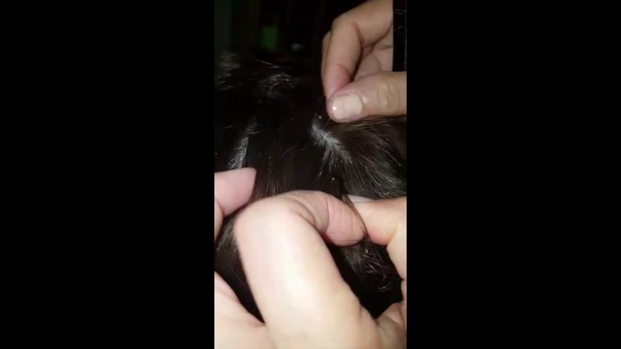 After shower loose dandruff Comb Pick! (Part 1) Soft talking comb ASMR