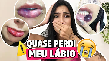 Como saber se o preenchimento labial deu certo?