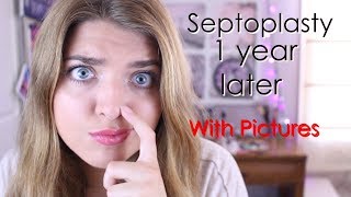 pix Septoplasty Before And After Inside septoplasty surgery 1 year later update with pictures