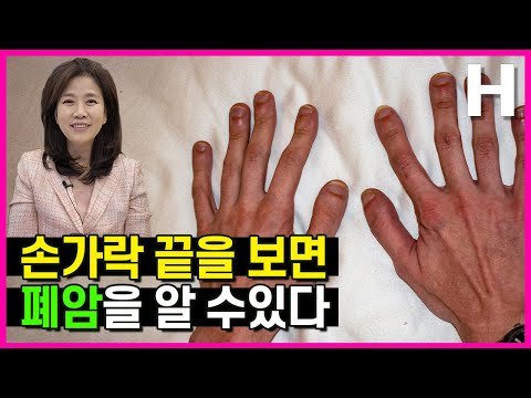 손끝을 보면 폐암을 알 수 있다?! 폐암 가능성을 알리는 손톱, 곤봉지 체크법 알려드립니다