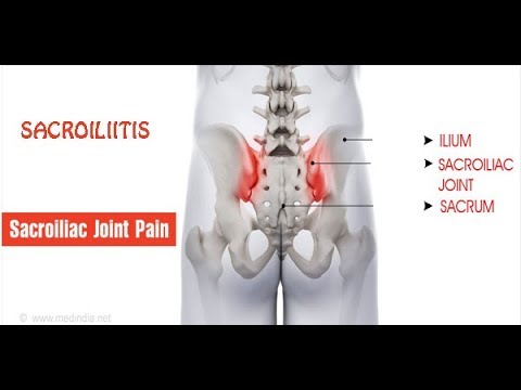 सैक्रोइलिइटिस ( Sacroiliitis PAIN ) कारण लक्षण और निदान एवं लाभदायक योग !!