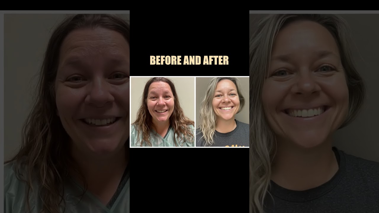 Kropps konturering etter vekttap