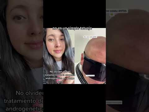 Micropigmentación y alopecia