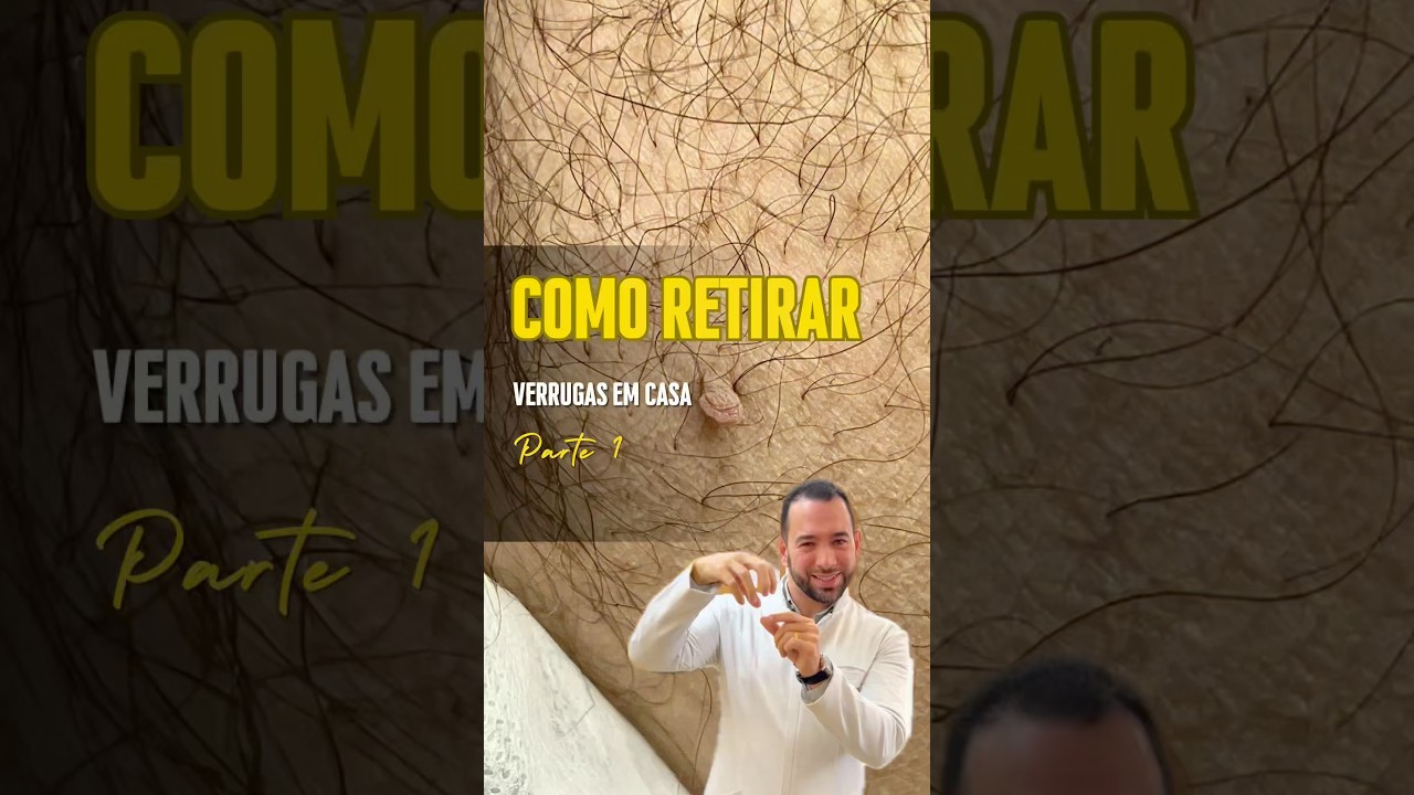 Como retirar verrugas em casa, fibroma mole e acrocórdons. Sem dor. Técnica caseira atualizada.