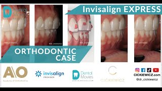Orthodontic case -  INVISALIGN Express - TRAUMATIC BITE / CROWDINGS / ROTATIONS