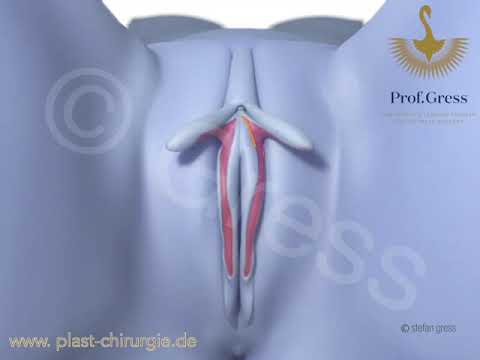 Labiaplasty - Labia minora reduction with correction of clitoral protrusion