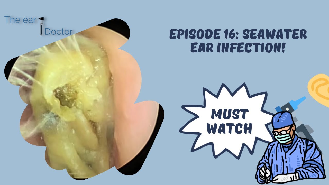 Episode 16 seawater ear infection YouTube