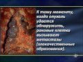 Рак Ротовой Полости 2