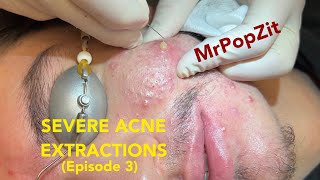 Severe Acne Extractions episode 3. The final episode, part 3 of 3. Giant waxy plugs removed.