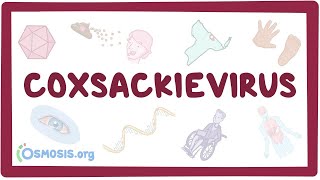 Coxsackievirus - An Osmosis Preview