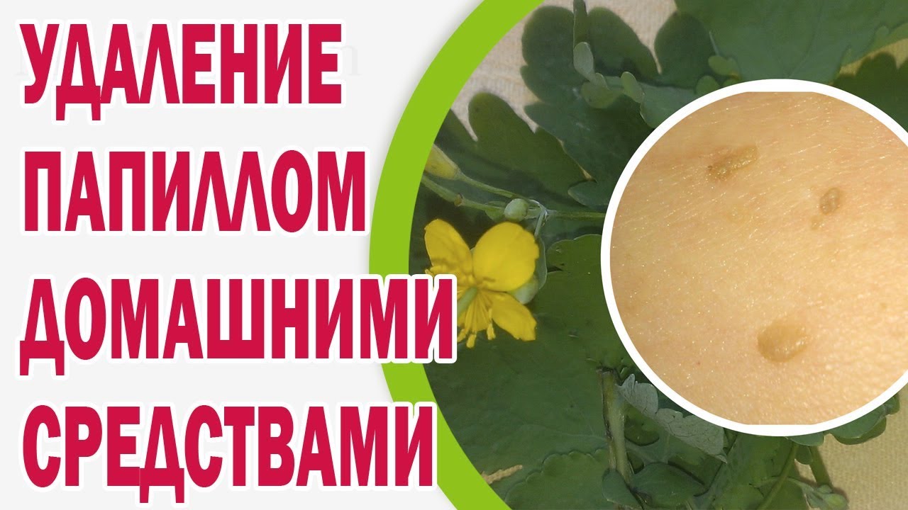 Удаление папиллом в колпино
