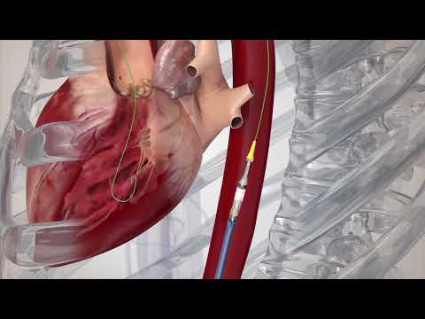 TAVI(経カテーテル的大動脈弁植え込み術)動画（TF）
