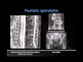 Dr. Rick Chatwell: Psoriatic Arthritis