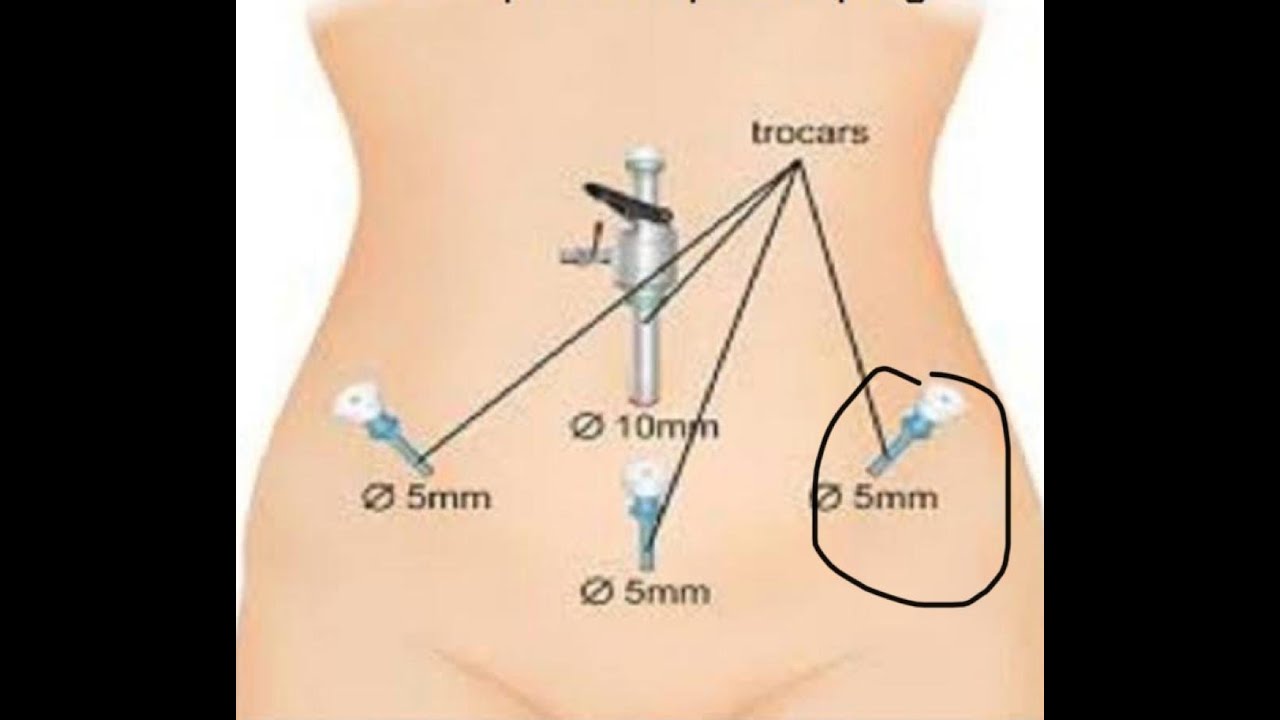 Точка после введения. Лапароскопия миомэктомия. Лапароскопическая аппендэктомия лапароскопия. Лапароскопия картинки. Разрезы при лапароскопии.
