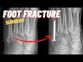 FIXING A FIFTH METATARSAL FRACTURE | Jones Fracture | Dr. Nick Campitelli