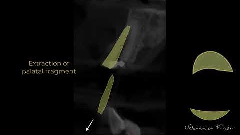 Socket Shield Surgical Technique
