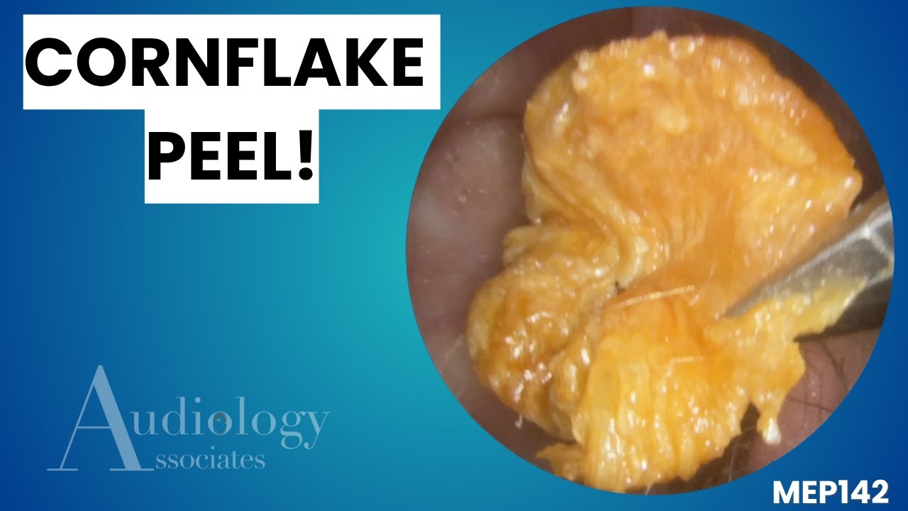 Dry Skin Plate & Cornflake Plug - MEP142 - YouTube