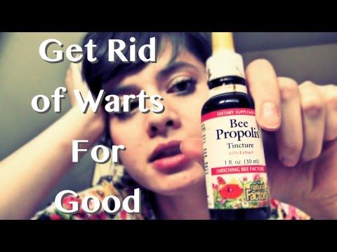 How To Get Rid of Warts - A Natural CHEAP Solution (Bee Propolis) - YouTube
