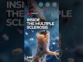 How MS Damages Your Nerves And How Stem Cells Help Multiplesclerosis Ms Shorts How MS Damages Your Nerves And How Stem Cells Help Multiplesclerosis Ms Shorts