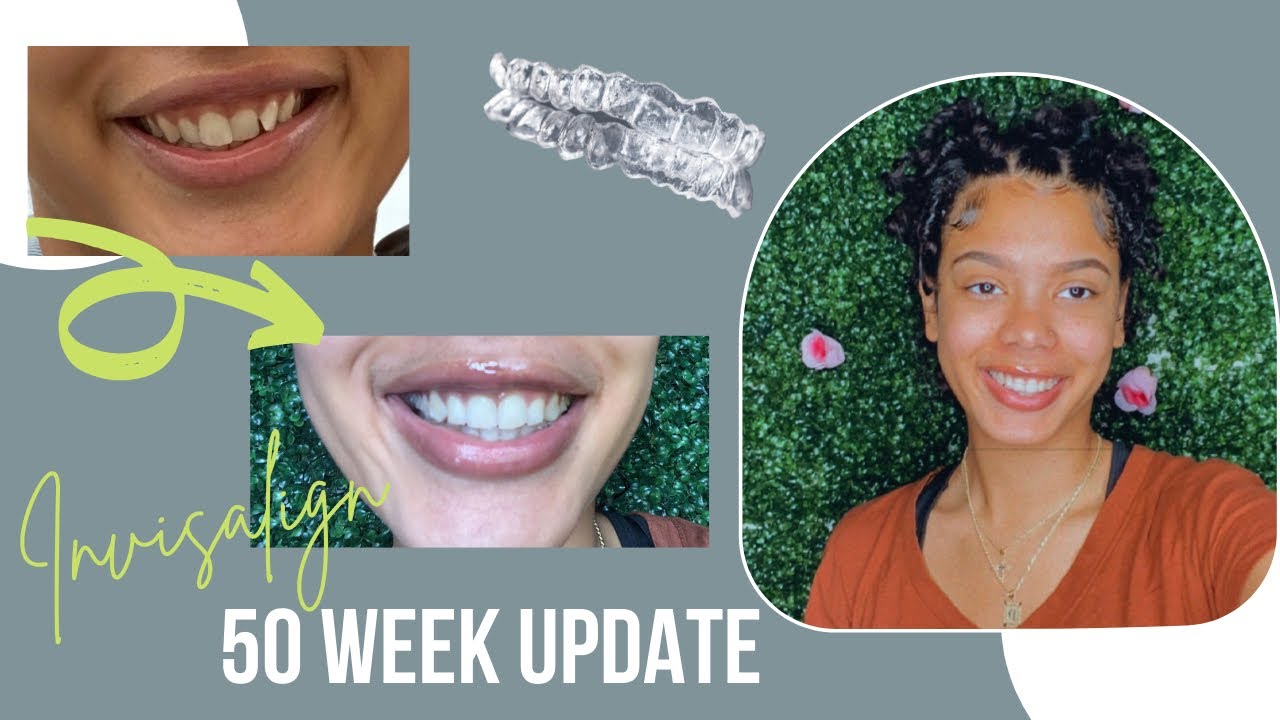 INVISALIGN JOURNEY UPDATE Does it work? Progress, pain management & tips YouTube