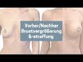 BrustvergrößErung Von A Auf C Vorher Nachher Bilder