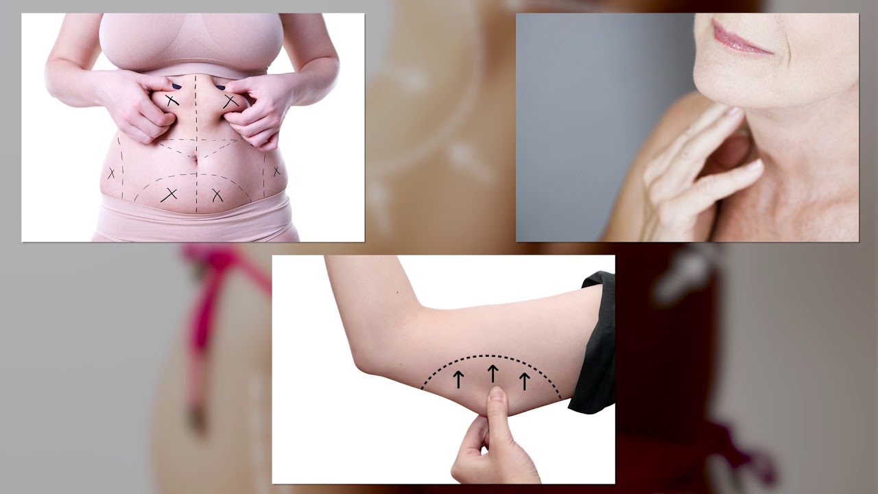 Renuvion Tightens Skin Before Your Very Eyes