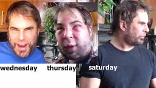 MY FACE IS NO LONGER SWOLLEN - THIS IS MARCH 20, 2021 Wealth