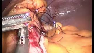 Op. Dr. Cemal Kara - Slevee Gastrektomi Operasyonunda Güvenliği Arttırmak Için Ilave Dikiş Konması