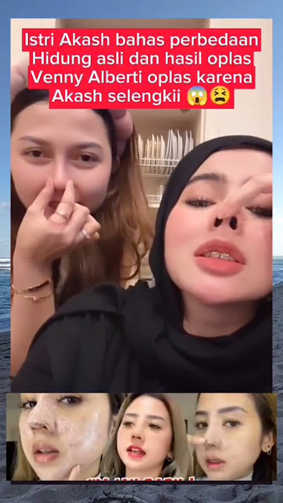 Istri Akash lagi bahas hidung Venny Alberti yang OP