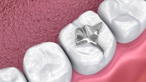 Amalgam Filling Procedure - Step by Step
