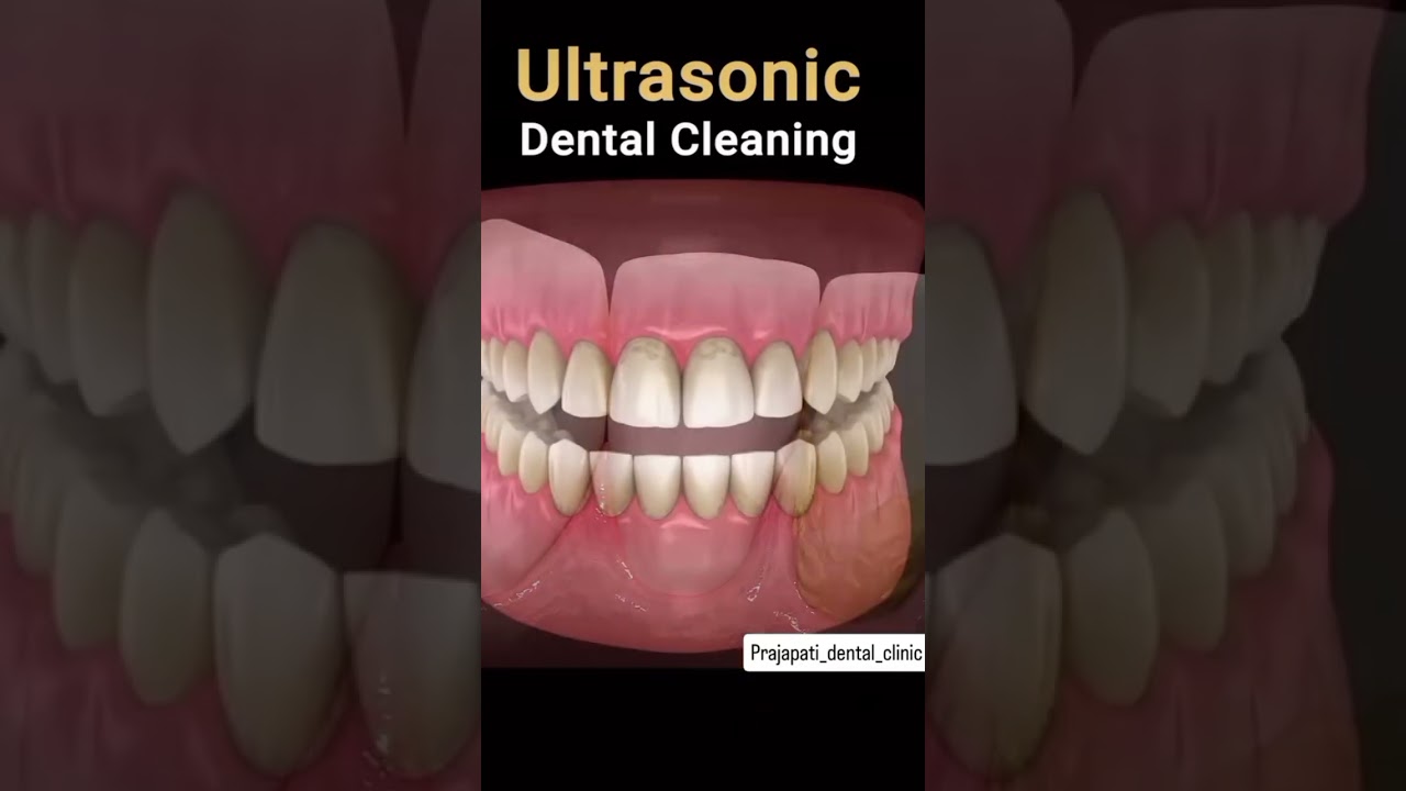 ultrasonic scaling.. teeth cleaning 