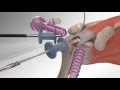 Rotator Cuff Repair with Arthrex® SpeedBridge™