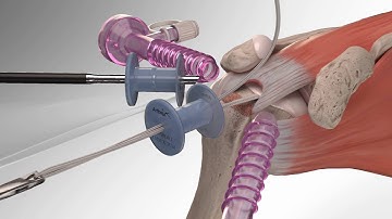 Rotator Cuff Repair with Arthrex® SpeedBridge™