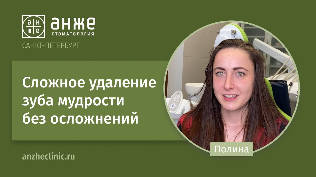 Сложное удаление зуба мудрости без осложнений - YouTube