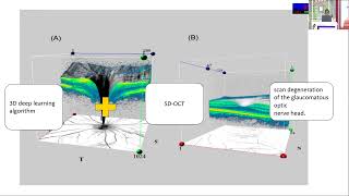 Information AIOC2026   ToT24   T Dr Vidushi Dixit AI in early dectection of glaucoma News