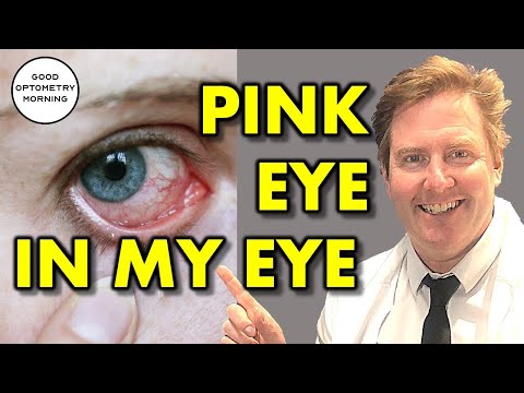WHAT IS PINK EYE: conjunctivitis, red eye infections, types & treatment from your youtube eye doctor